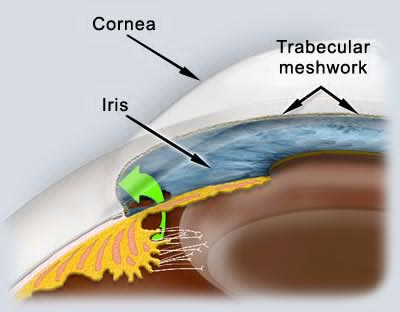 glaucoma 6.jpg